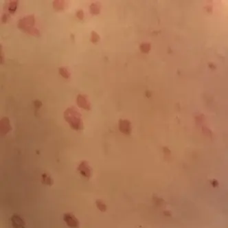 Low-resolution close-up photograph of psoriasis spots across B’s back